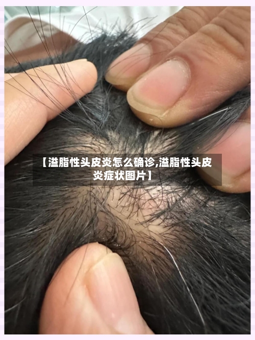 【溢脂性头皮炎怎么确诊,溢脂性头皮炎症状图片】