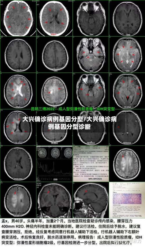 大兴确诊病例基因分型/大兴确诊病例基因分型诊断