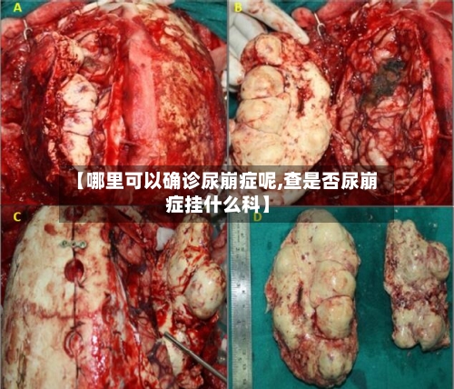 【哪里可以确诊尿崩症呢,查是否尿崩症挂什么科】-第2张图片